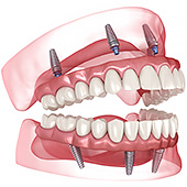 зубные импланты