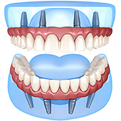 еще картинка с зубными имплантами